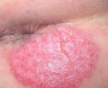 肛门湿疹的病因有哪些呢？