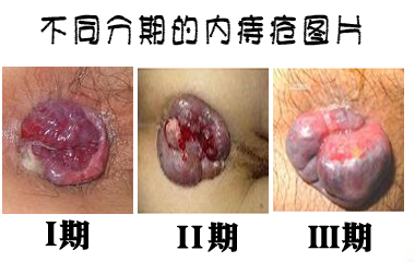 内痔的原因