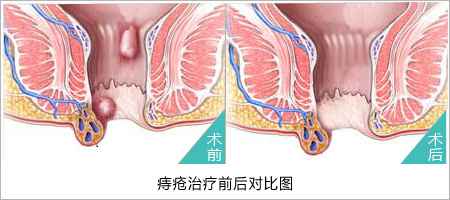 内痔术前与术后对比图